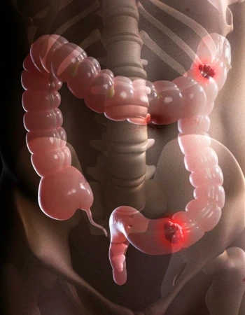 Cáncer de Colon en Celaya