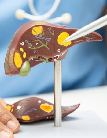 cancer de higado Cáncer de Hígado en Celaya