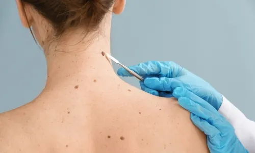 cancer de piel en celaya Oncólogo en Celaya
