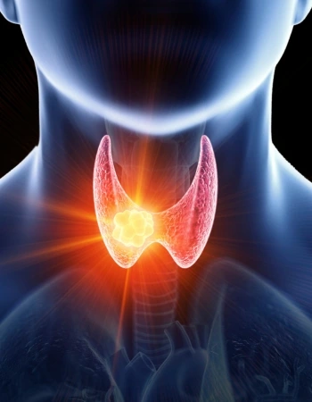 cancer de tiroides Especialistas en Cáncer de Tiroides en Celaya