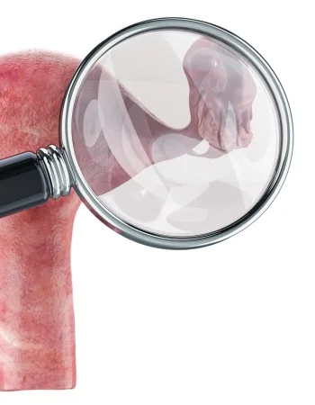 ovarios cancer Cáncer de Ovario en Celaya